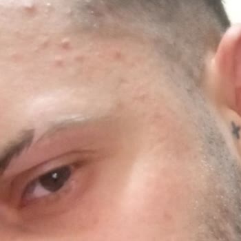 Bee Beauty Yüz Toniği Cildimi Haşladı