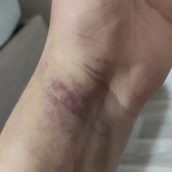 İlhan Özdemir Hastanesi Kan Alma İşleminde Yaşanan Sorun Ve Sonuçları