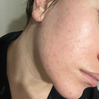 Neutrogena Peeling Jel Alerji Sorunu