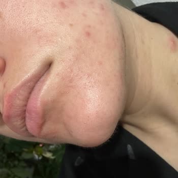 Neutrogena Peeling Jel Alerji Sorunu