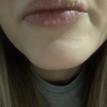 Flormar Dudak Ürününden Kaynaklanan Ciddi Sorunlar