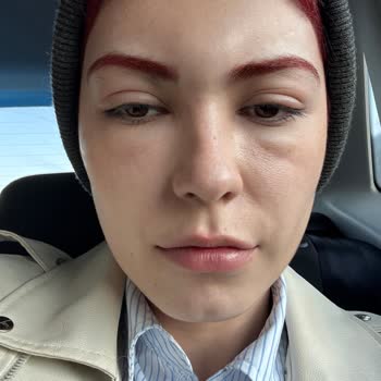 Saç Boyası Alerjisi Ve Yan Etkileri