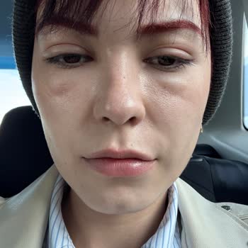 Saç Boyası Alerjisi Ve Yan Etkileri