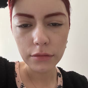 Saç Boyası Alerjisi Ve Yan Etkileri