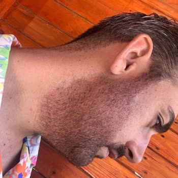 Phyto Color Hair & Beard Dye Caused Skin Burns and Irritation