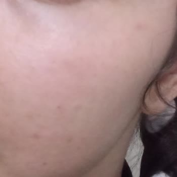 Bee Beauty Vücut Spreyi Alerjik Reaksiyonlara Neden Oluyor