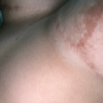 Estetik Ameliyat Hayal Kırıklığı