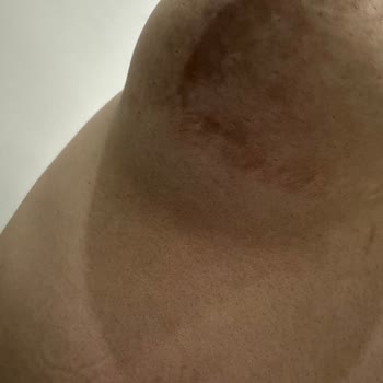 Estetik Ameliyat Hayal Kırıklığı