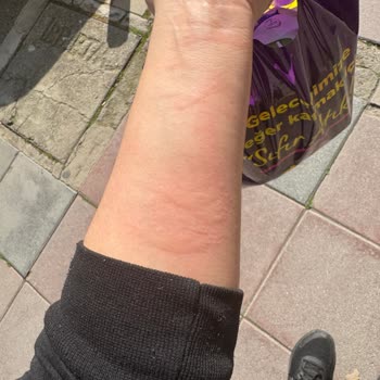 Alerji Yapan Parfüm Kabusu