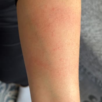 Alerji Yapan Parfüm Kabusu