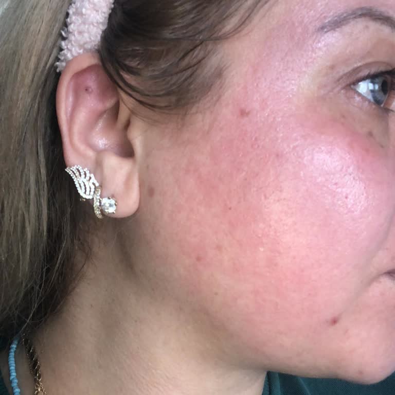 Kırmızı Peeling Yüzümde Yanma Ve Batma Yaptı