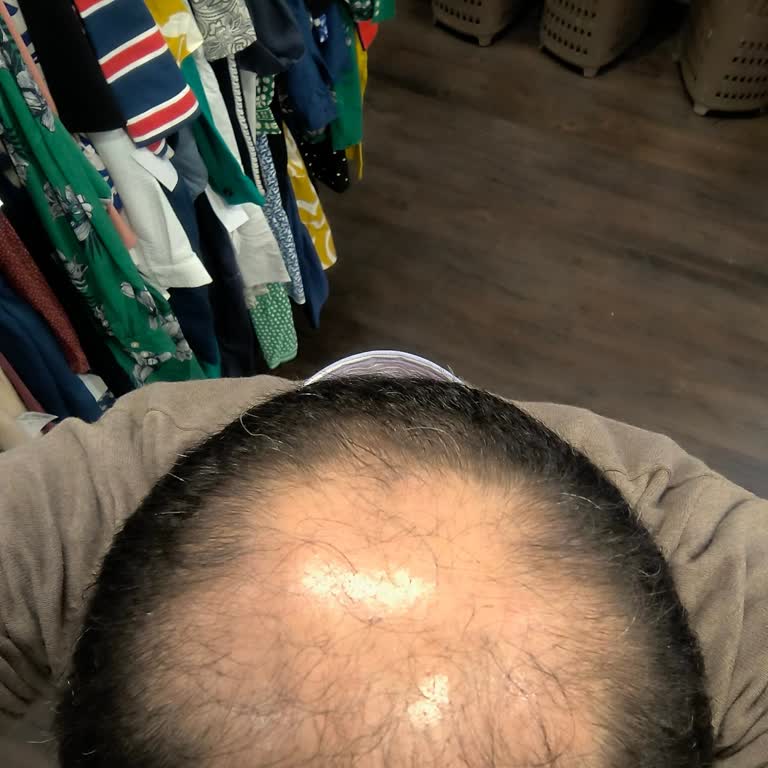 Ekrem Civas Klinik Saç Ekimi Sonrası Hayal Kırıklığı