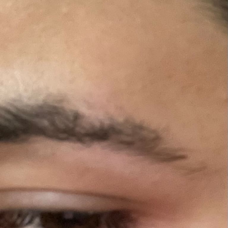 Mes Beauty Center Lazer Epilasyonda Yanık ve Mağduriyet