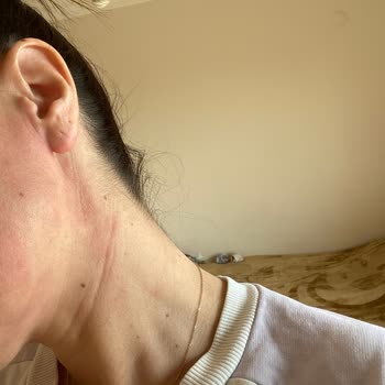 Yves Rocher Şampuanı Alerjik Reaksiyon Yarattı