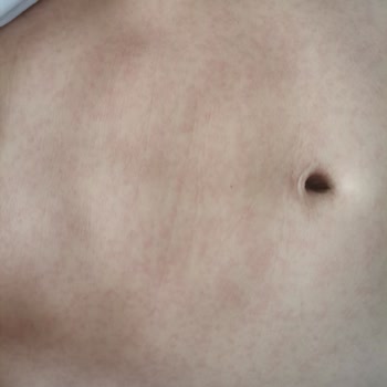 Berko İlaç Yan Etkilerle Mücadele: İlaç Kullanımında Yaş Sınırı Sorunu!