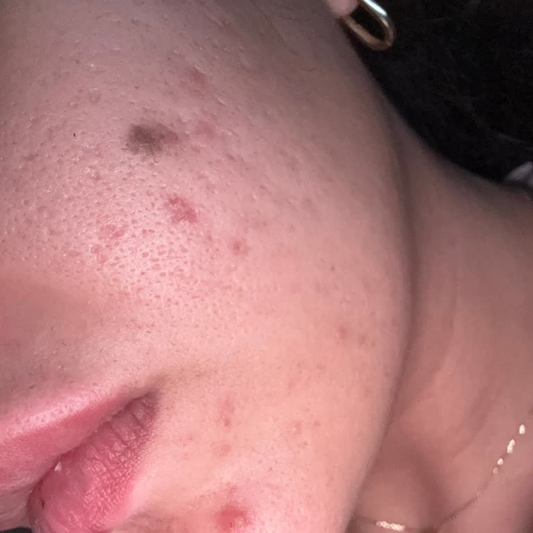 Caudalie Vinopure: Неэффективность после 2 месяцев использования