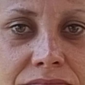 Başarısız Burun Ameliyatları Ve Sürekli Ağrı