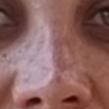 Başarısız Burun Ameliyatları Ve Sürekli Ağrı