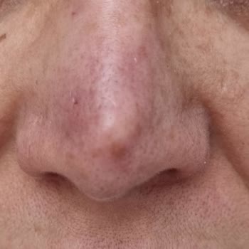 Başarısız Burun Ameliyatları Ve Sürekli Ağrı