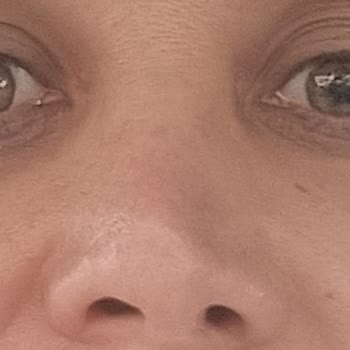 Başarısız Burun Ameliyatları Ve Sürekli Ağrı