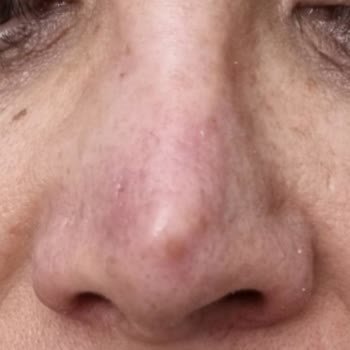 Başarısız Burun Ameliyatları Ve Sürekli Ağrı