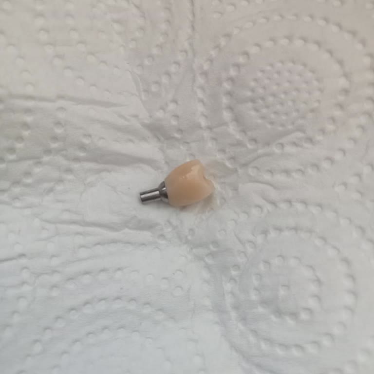 İmplant İşkencesi: Güvenerek Gittiğim Yerde Mağdur Oldum