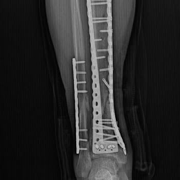 Engellilik Oranı Değerlendirmesinde Yanlışlık