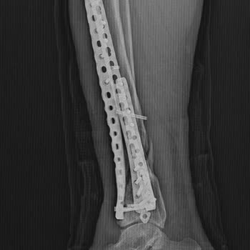Engellilik Oranı Değerlendirmesinde Yanlışlık