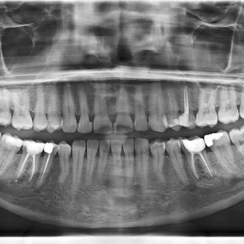 Vadi Dental Ağız ve Diş Sağlığı Polikliniği Kanal Tedavisi Kabusu: Ağrı ve Maliyet Çıkmazı