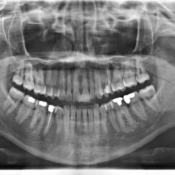 Vadi Dental Ağız ve Diş Sağlığı Polikliniği Kanal Tedavisi Kabusu: Ağrı ve Maliyet Çıkmazı