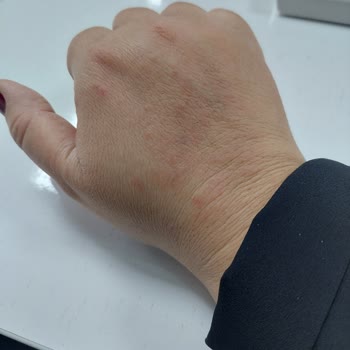 Neutrogena Ürünü Yüzümde Yanık Ve Kızarıklık Yaptı!