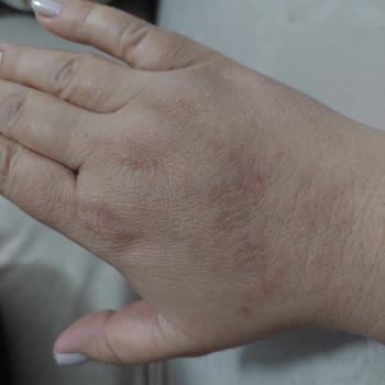 Neutrogena Ürünü Yüzümde Yanık Ve Kızarıklık Yaptı!