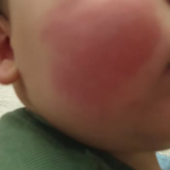 Mustela Arnica Jel Kullanımı Sonrası Beklenmedik Cilt Reaksiyonu