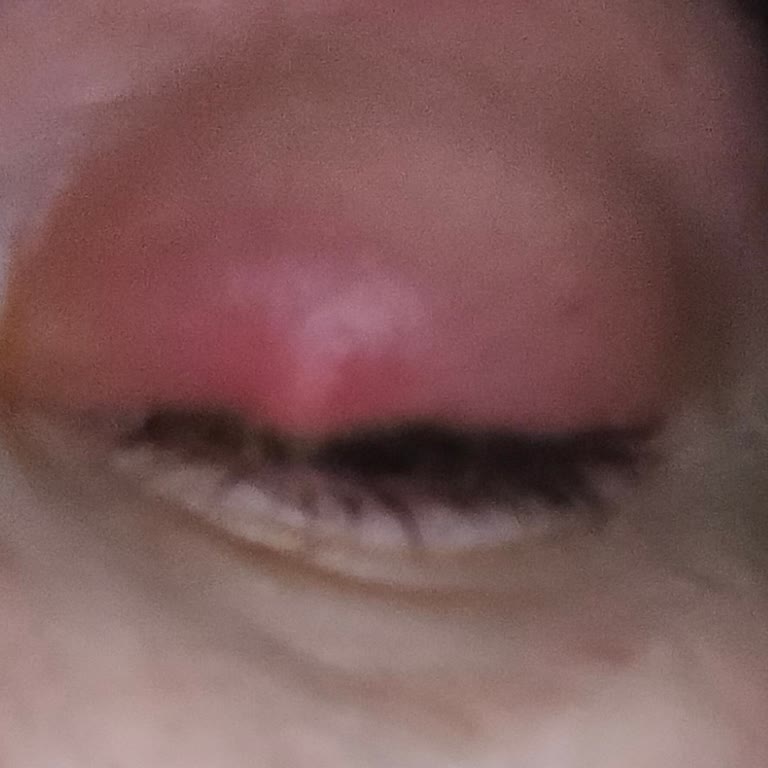 Yanlış Müdahale Sonrası Gözüm Daha Da Kötüleşti