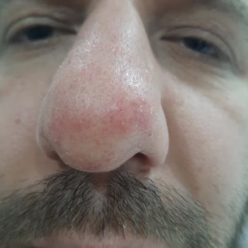 La Roche-Posay Moisturizer & Shampoo Caused Redness, Acne & Itching
