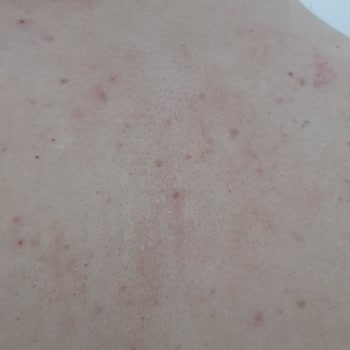La Roche-Posay Moisturizer & Shampoo Caused Redness, Acne & Itching