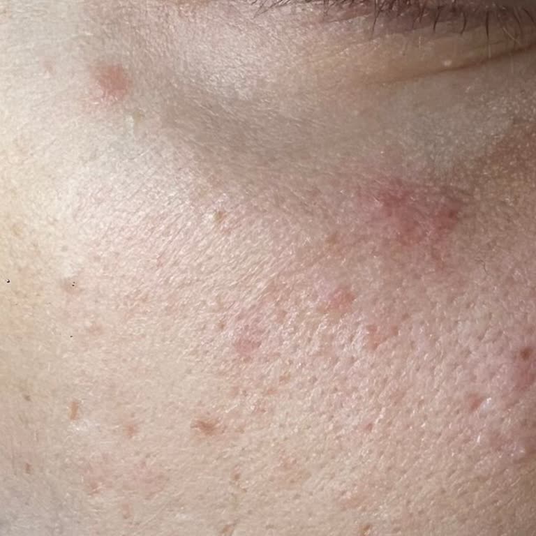 La Roche-Posay Cicaplast Baume B5+ Gave Me a Rash