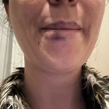 Estrella Güzellik Merkezinde Olumsuz Dolgu Deneyimi