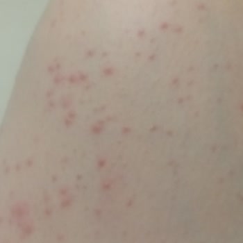 Apranax Ciltte Leke Yaptı!