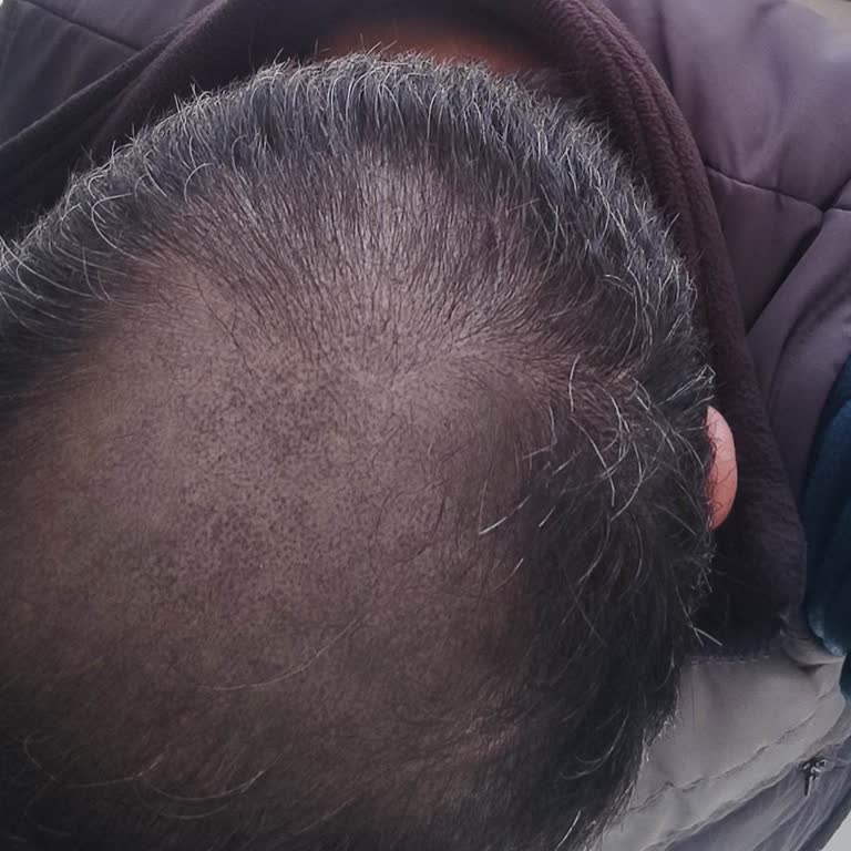 His Hair Center | Ankara Saç Simülasyonu Renk Değişimi Hayal Kırıklığı