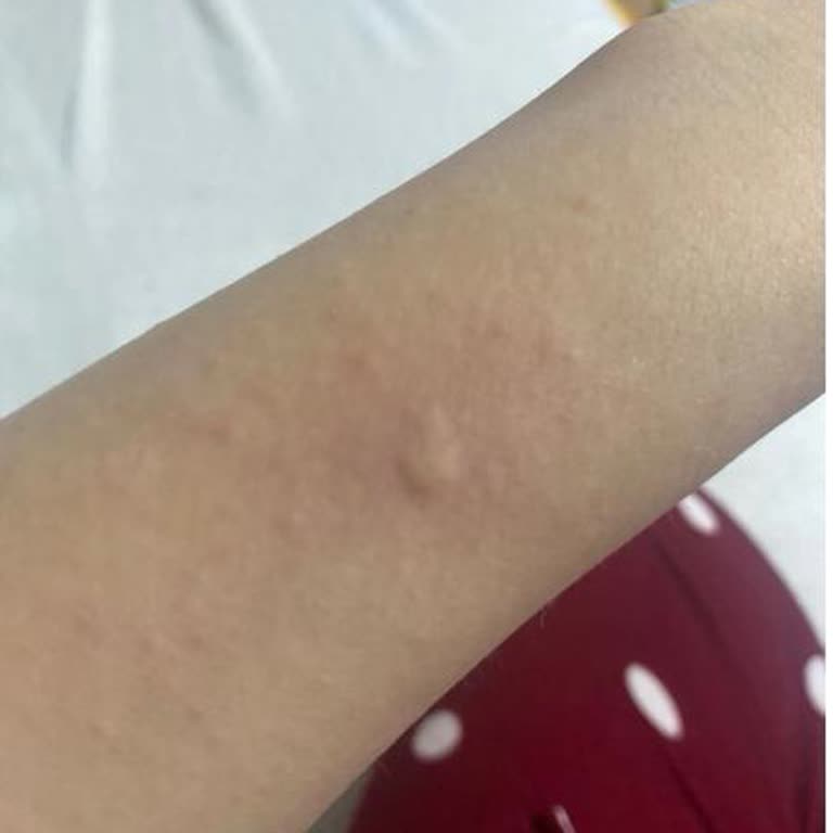 Cilt Hassasiyeti Olan Ürün İadesi Reddedildi