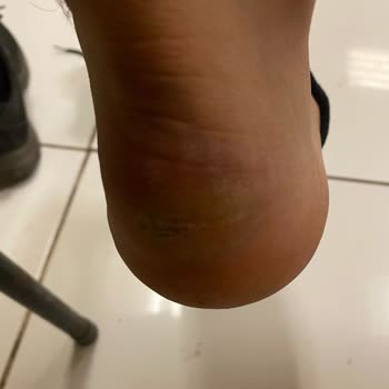 Kısa Sürede Yıpranan Ayakkabı Ve Garanti Sorunu