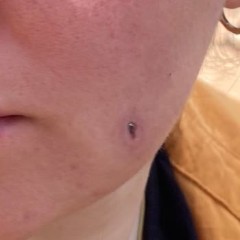 Lazer Uygulaması Sonrası Yüzümde Kalıcı Hasar Oluştu