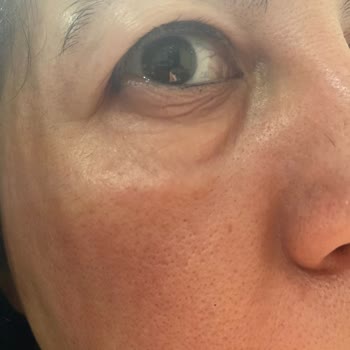 Estee Lauder Krem Yüzümü Mahvetti Yanma Ve Kızarıklık Geçmiyor