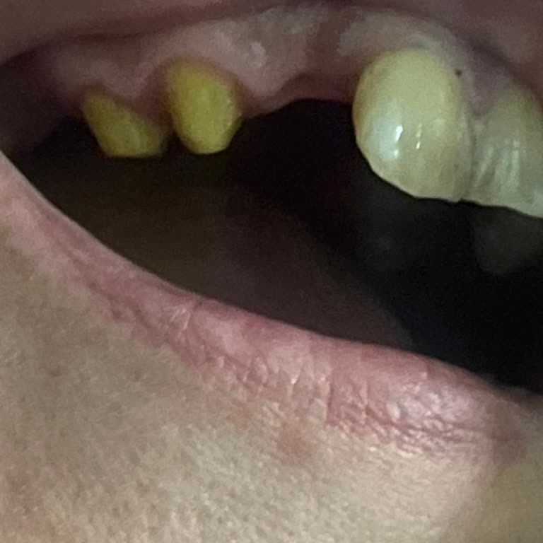 Estetik Diş Tedavisinde Beklenmedik Sonuç