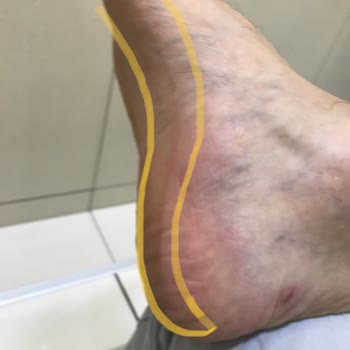 Mizuno Wave Rider Hurts My Heel – Defective Shoe Returned Without Fix