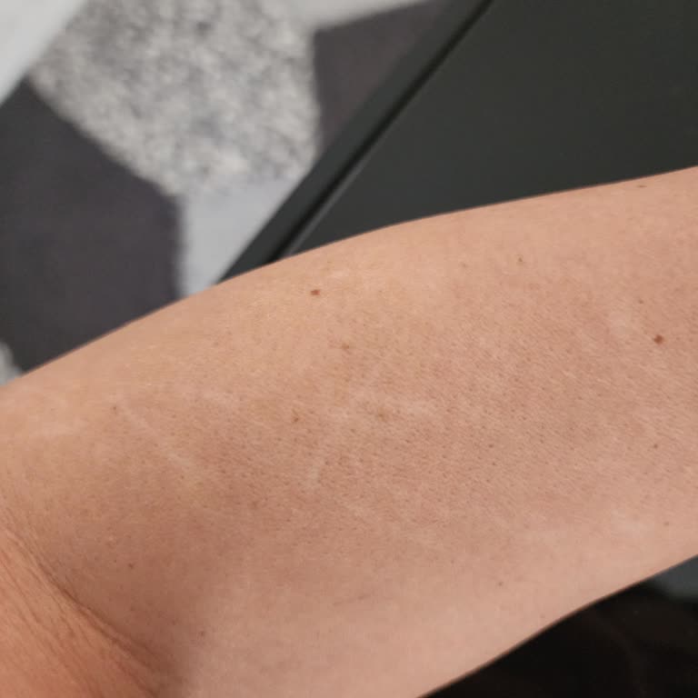 Braun Silk-Expert Pro5 Epilasyon Aleti İle Cilt Yanığı