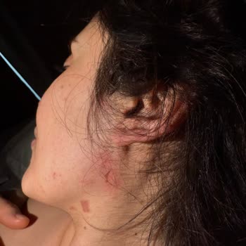 Lazer Epilasyon Sonrası Cilt Yanıkları