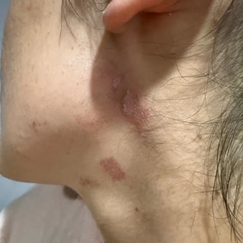 Lazer Epilasyon Sonrası Cilt Yanıkları