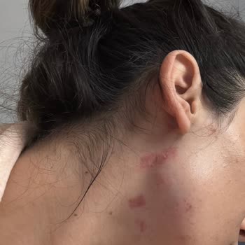 Lazer Epilasyon Sonrası Cilt Yanıkları